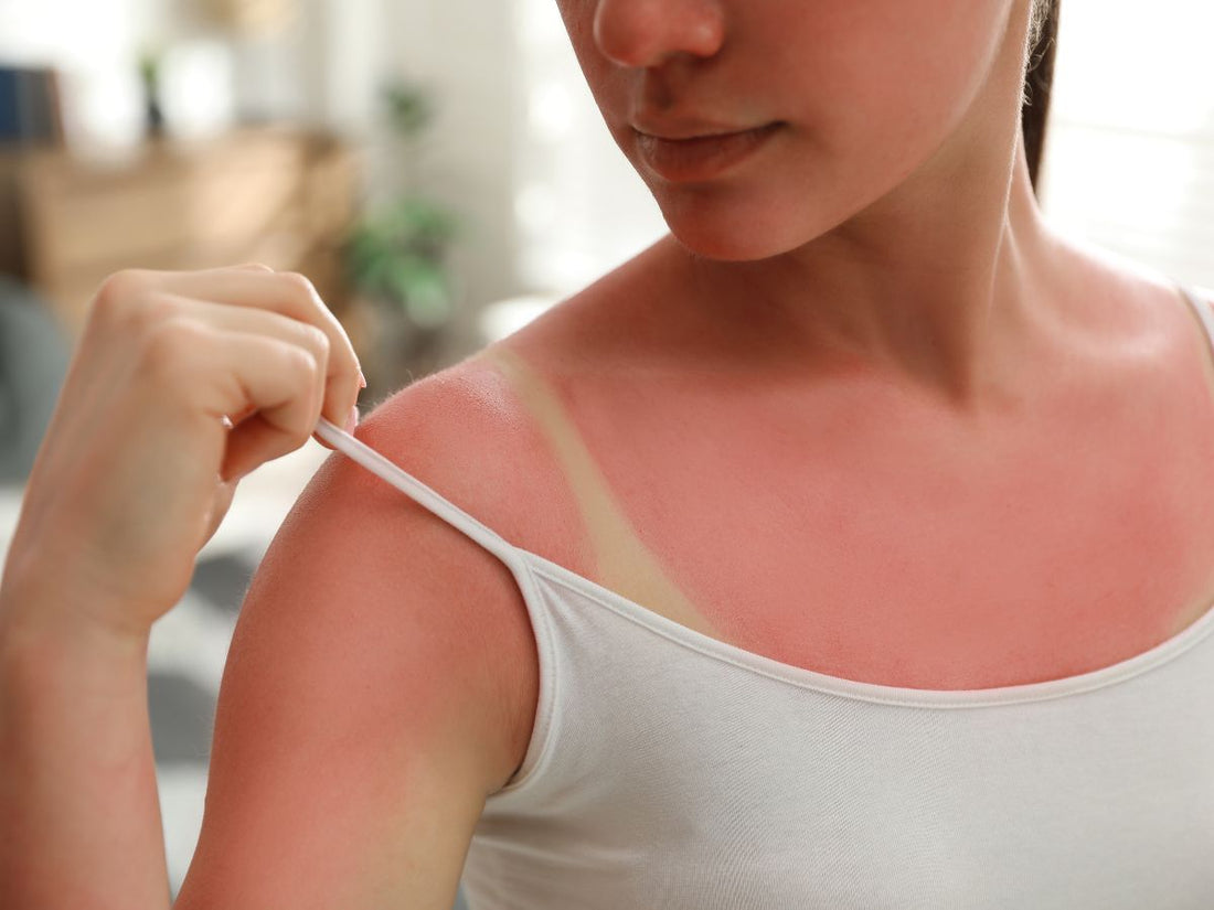 showing sunburn on shoulder, indicating the need for sunburn relief.